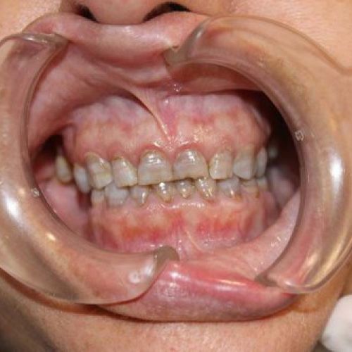 Odontología estética antes