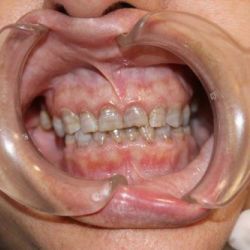 Odontología estética antes