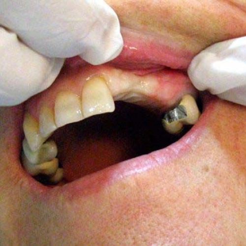 implantes después