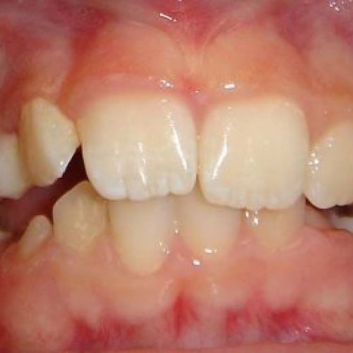 ortodoncia antes